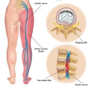 Sciatica