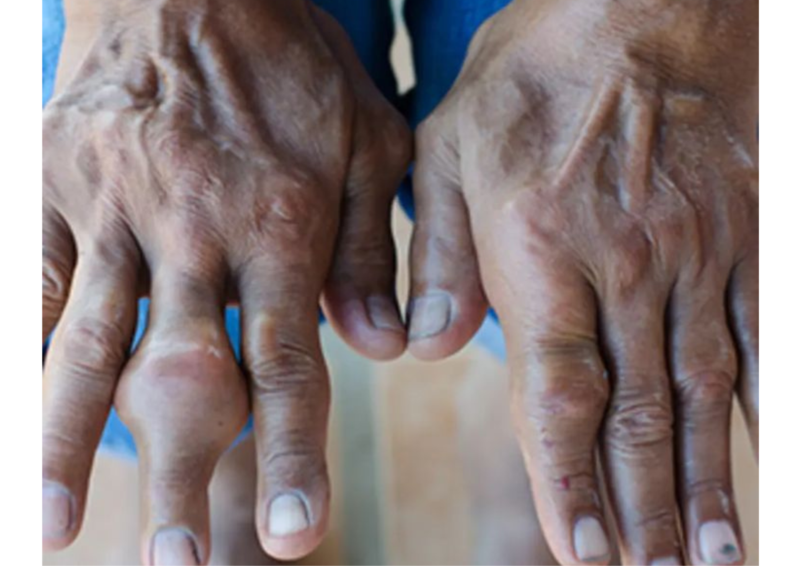 Gout Through