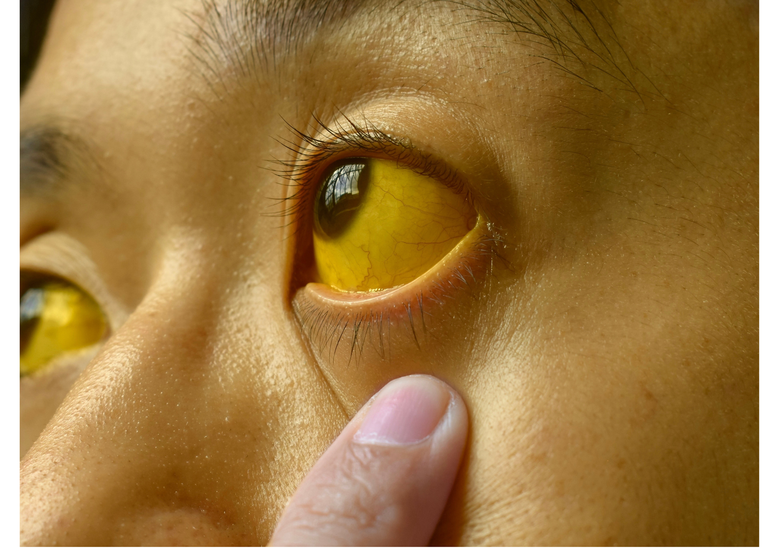 Jaundice